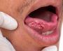 Tongue Cancer Treatment in Ahmedabad