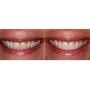 Affordable Porcelain Veneers in Colombia | Dublin Metro Dent