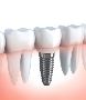 Expert Implant Dentist in Dublin -  Dublin Metro Dental