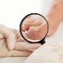Best Treatment for Ingrown Toenail in Bundoora