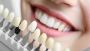 Dental Veneers In Raleigh, NC