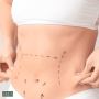 Abdominoplasty in Dubai | Achieve a Tighter Tummy at Ecla