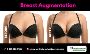 Affordable Cost of Breast Augmentation Treatment in Mexico