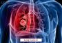 Searching for reliable Lung Cancer Treatment?