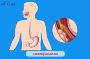 Looking for reliable Esophagus Cancer Treatment?
