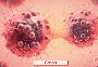 Looking for advanced Ovarian Cancer Treatment?
