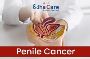 Looking for advanced Penile Cancer Treatment?