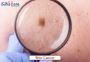 Looking for advanced Skin Cancer Treatment?