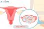 Looking for advanced Vaginal Cancer Treatment?