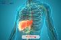 Hepatology Treatment in India | Edhacare Medical Tourism