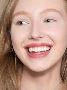 Dental Veneers in Dubai