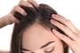 Homeopathy Medicine for Dandruff