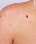 Best Mole Checks in Niddrie 