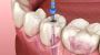Best root canal dentist in Paschim Vihar