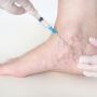 Pain-Free Solutions for Varicose Veins treatment in Maryland