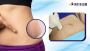 Stretch Mark Removal in Surat