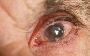 Understanding and Treating Glaucoma