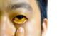 Yellow Eyes: What It Means and How to Treat It