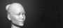 Chin Reduction Cost in India 