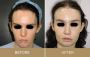 Facial Feminization Surgery India