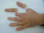 Custom Finger Amputation Prosthetics in Atlanta, GA