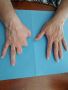 Prosthetics for Thumb Loss | Restore Function and Mobility