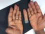 Realistic Silicone Thumb Prosthetics for Daily Comfort