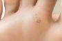 Verrucas Treatment In Halifax, UK