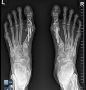 Innovations in Minimally Invasive Bunion Surgery