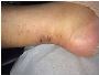 Achilles Surgery: What Can I Expect at Home?