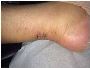 Common Problems After Achilles Tear Surgery