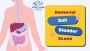 Quick and Safe Gall Bladder Stone Removal at Fortune Hospita