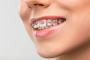 Braces Singapore - Free Consultation & Affordable Treatment