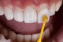 Classified Ad: Veneers in San Antonio, TX – Geo Dental