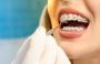 Braces In Raleigh, NC