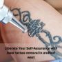 Liberate Your Self-Assurance with Tattoo Removal in Andheri