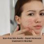 Scar-Free Skin Awaits – Expert Acne scar treatment in andher