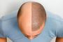 Hair Aesthetica Offers Affordable Hair Transplant Cost