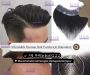 Affordable and Long-Lasting Human Hair Patches in Bangalore