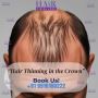 "Hair Thinning in the Crown? What You Can Do"