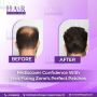 "Why Men Lose Hair in the Crown and the Best Fixes"