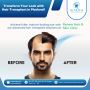 Hair Transplant in Madurai – Renew Hair and Skin Care Clinic