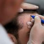 Hair Replacement Cost