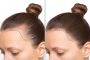 Dermacian’s Guide to Lasting Hair Restoration