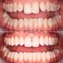 Perfect Smile Makeover with a Professional Touch!