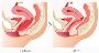 How Can an Atlanta ThermiVa Treatment Help?