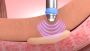 The Best Thing About GAINSWave Therapy In Atlanta
