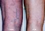 GET YOUR YOUTHFUL SKIN BACK WITH VEIN THERAPY IN ATLANTA