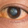 Harley Vision: Cataract Eye Surgery Cost and Affordable Visi