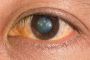 Trusted Eye Lens Replacement Surgery Experts – Harley Vision